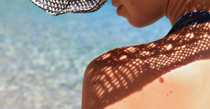 Sun Damanged Skin